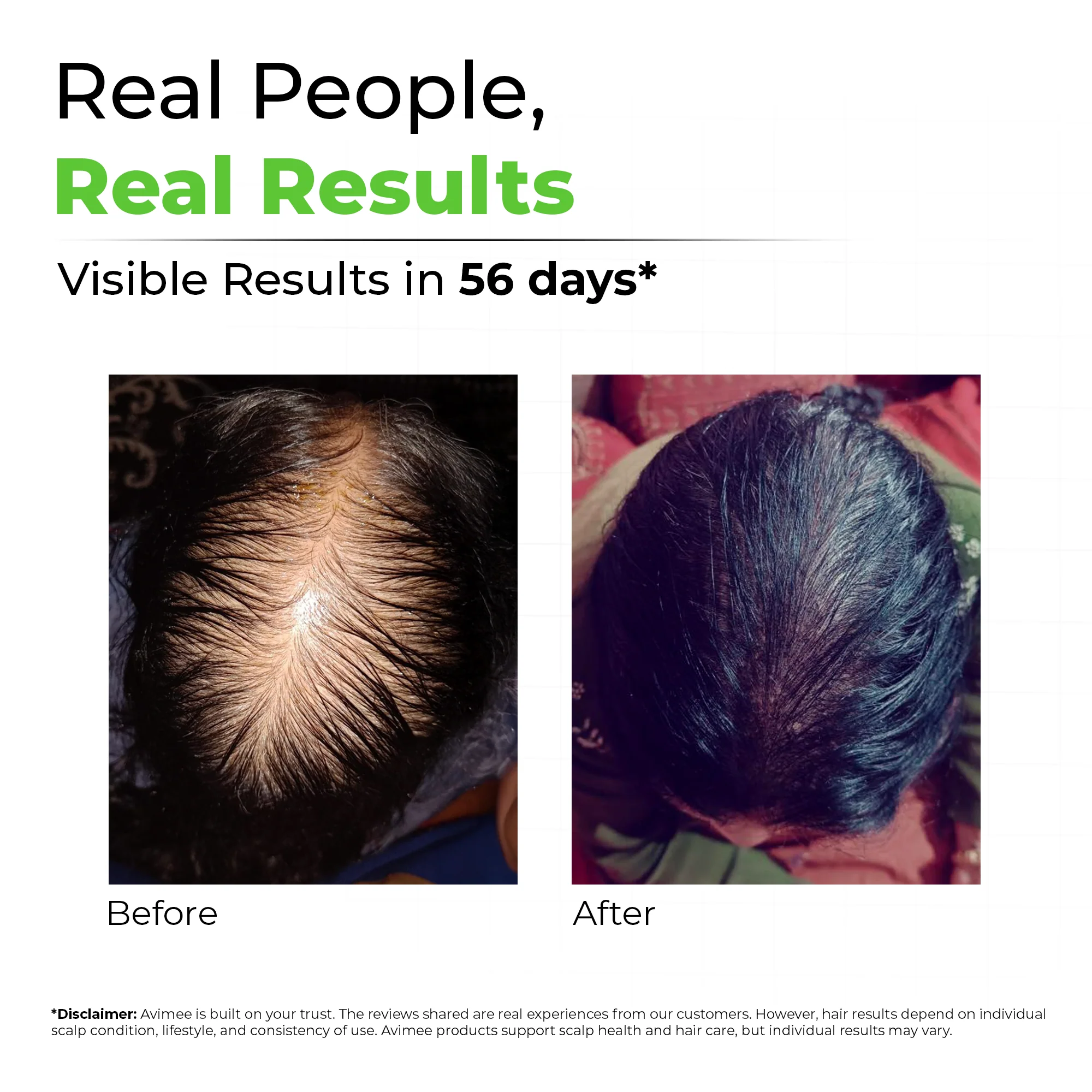 Scalptone Hair Growth Serum with 5% Nansyl & Pea Sprout Extract - Image 3