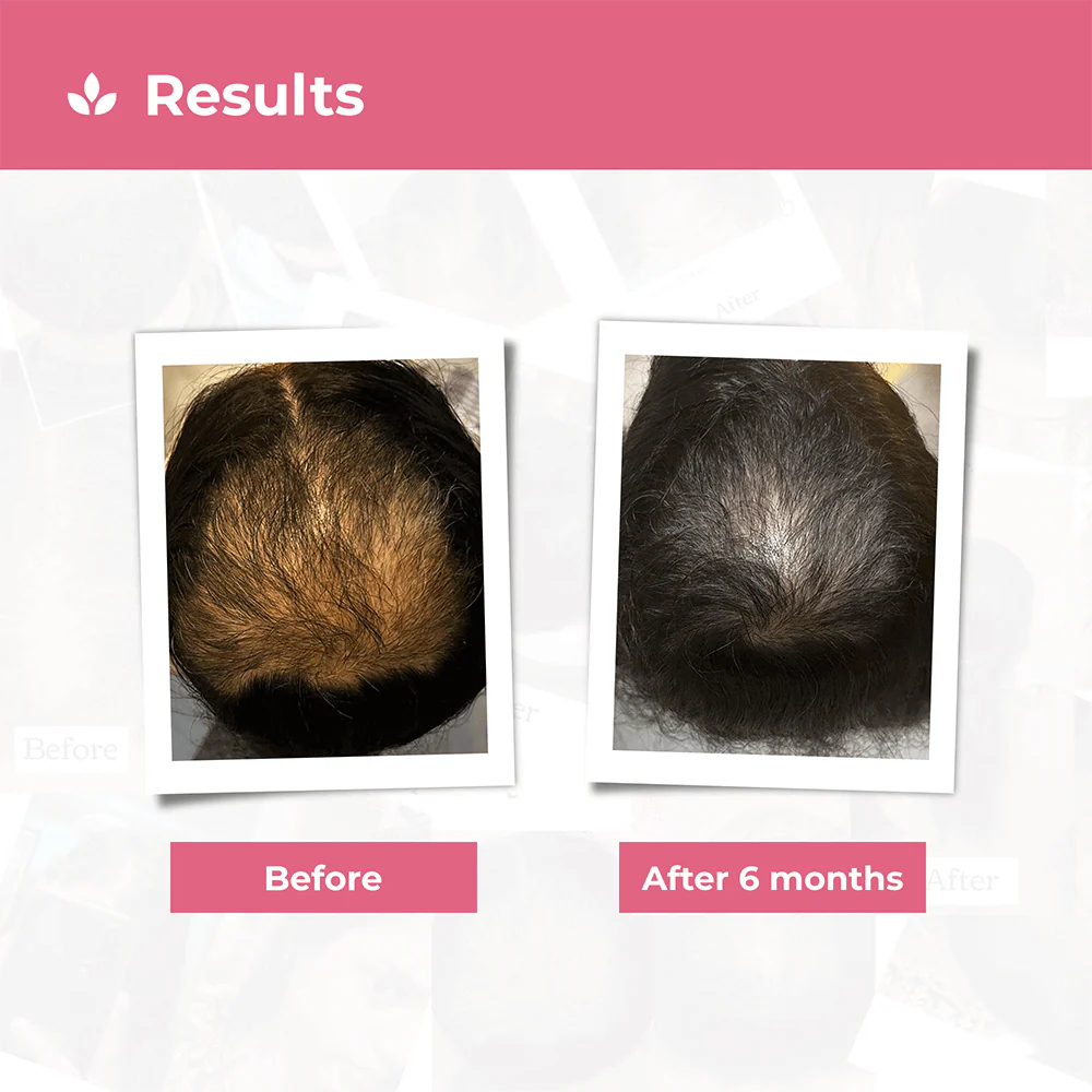 Hair Growth Kit for Stage 3 Hair Loss - Image 4